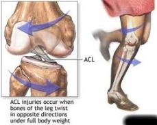 ACL